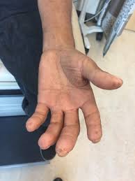 Attēlu rezultāti vaicājumam “Scleroderma”