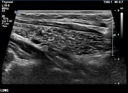 Image result for Thymus