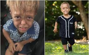 Image result for Nanismo Primordial