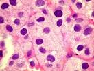 era o habitual em <b>adenomas</b>
