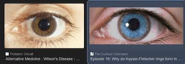 Kuvahaun tulos haulle Kayser-Fleischer