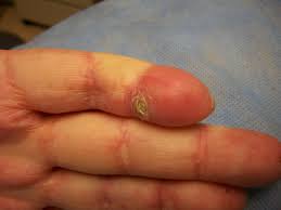 Attēlu rezultāti vaicājumam “Scleroderma”