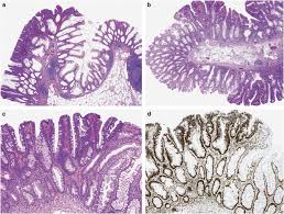 Attēlu rezultāti vaicājumam “Diderma simplex sessile”