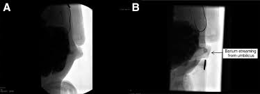 Attēlu rezultāti vaicājumam “Diderma umbilicatum young”