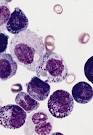 <b>Acute eosinophilic leukemia</b>.