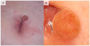 Attēlu rezultāti vaicājumam “Diderma umbilicatum young”