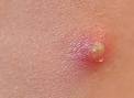 Vaginal Pimple Pictures - How To Treat & Tell If Your Vaginal Acne ...