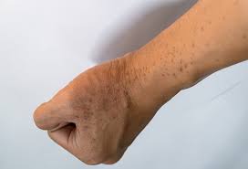 Attēlu rezultāti vaicājumam “Scleroderma”