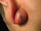 Sebaceous Cyst | Sebaceous Cysts | Sebaceous Cyst Pictures ...