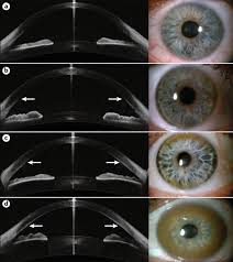 Kuvahaun tulos haulle Kayser-Fleischer