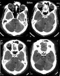 <b>Edema encefálico</b>
