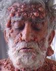 FACE: neurofibromatosis