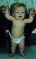 <b>Acondroplasia</b> - Información médica en Ferato, enciclopedia de la