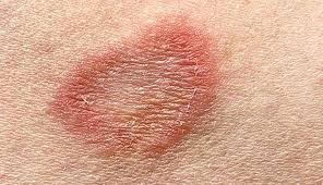 Image result for tinea corporis
