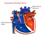 Transposition of the Great Arteries | Pediatric Heart Specialists