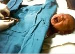  Circumcision Not Cost-Effective Says Study