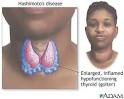 Chronic <b>thyroiditis</b> is an