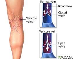 vv