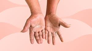 Attēlu rezultāti vaicājumam “Scleroderma”