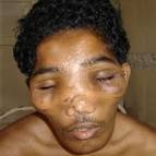 fibrous dysplasia.