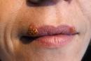 Slideshow: Coping With Cold Sores