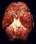<b>meningitis</b> infection due