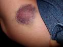 Your Dress Would Look Better On Me: Bruises All Around, Cheap and ...