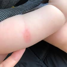 Image result for bed bug bites