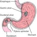 peptic ulcer - definition of peptic ulcer in the Medical ...