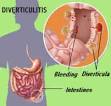 MoonDragon's Health & Wellness: DIVERTICULITIS