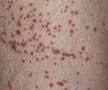 Idiopathic thrombocytopenic purpura - Wikipedia, the free encyclopedia