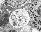 Final Diagnosis -- Case 137