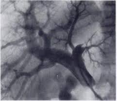 Image result for transumbilical portal-hepatography