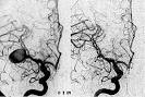 <b>Angiografía</b> cerebral de un