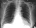 PULMONARY EMBOLISM