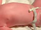 <b>umbilical cord</b> clamp, clamping