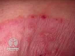 Image result for tinea corporis