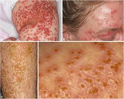 Attēlu rezultāti vaicājumam “Diderma simplex sessile”