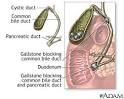 Gallstones and gallbladder disease - Symptoms