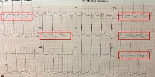 Image result for  ^ L V [ h    