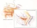 Vesico-<b>vaginal Fistula</b>