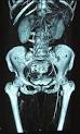 <b>thromboangiitis obliterans</b>