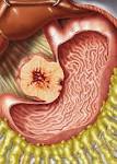 Gastrointestinal Stromal Tumor