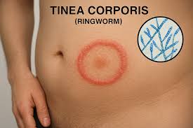 Image result for tinea corporis