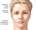 Prálisis Facial Central y Periférica | Fisioterapia Hoy