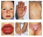 Kawasaki's Disease — NEJM