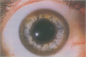 Kuvahaun tulos haulle Kayser-Fleischer