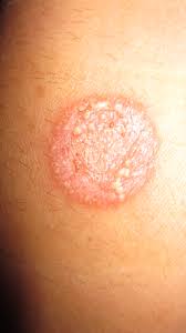 Image result for tinea corporis