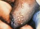 File:SOA-Herpes-genitalis-male.jpg - Wikipedia, the free encyclopedia