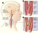 What Is Carotid Artery Disease? - NHLBI, NIH